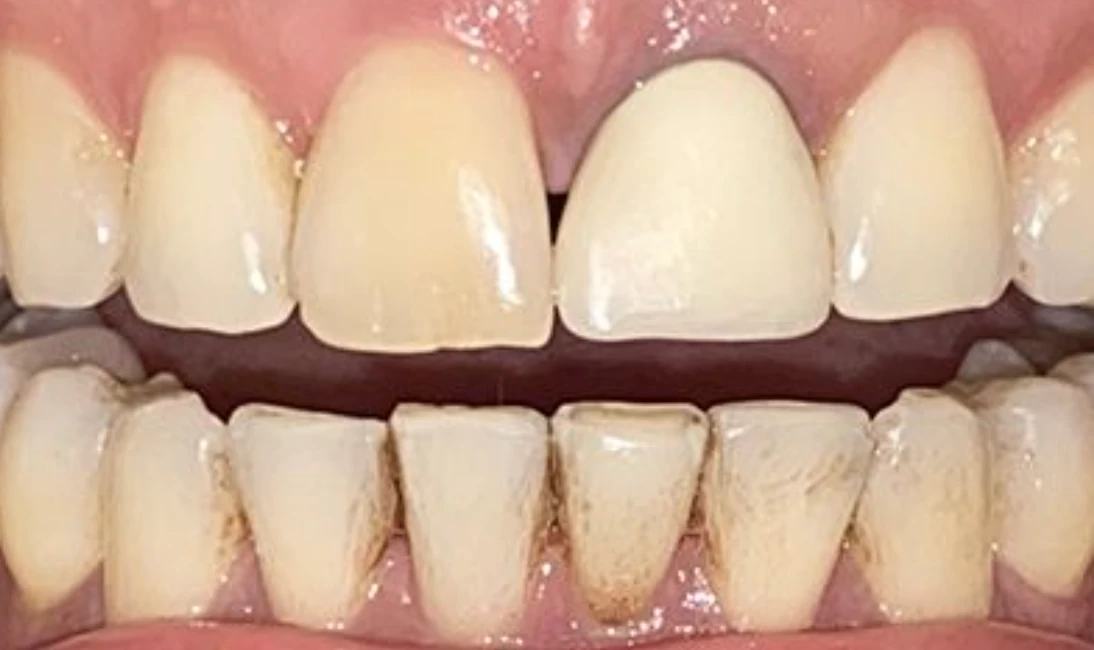 Porcelain Crowns & Restorative Care — before